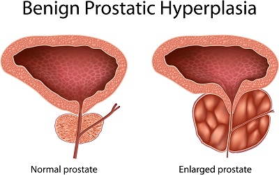 prostate health